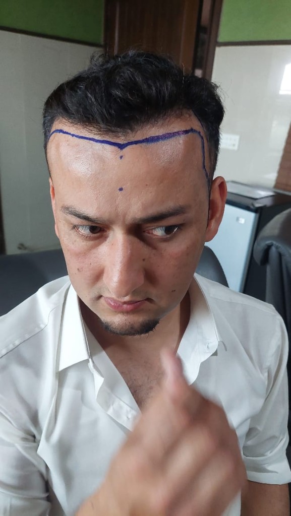 Hair-transplant-islamabad-01