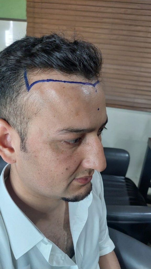 Hair-transplant-islamabad-0145