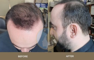 Thin Hair Transplant Result
