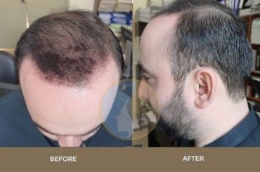 Thin Hair Transplant Result