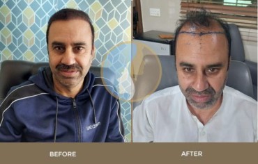 FUE Hair Transplant Result Islamabad