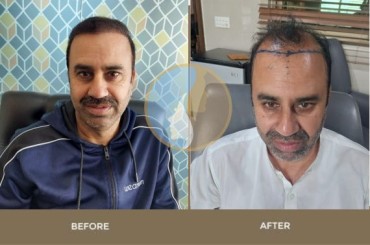 FUE Hair Transplant Result Islamabad