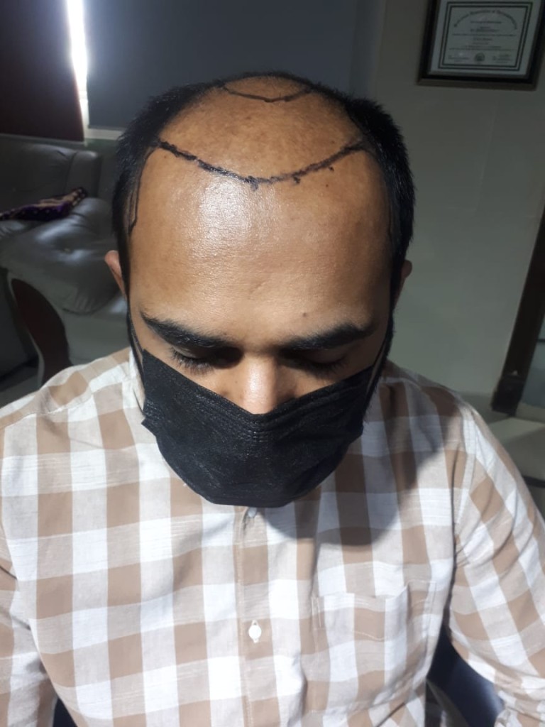Hair-transplant-islamabad-01