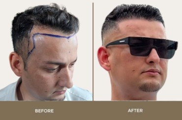Result of Hair Transplant In Islamabad