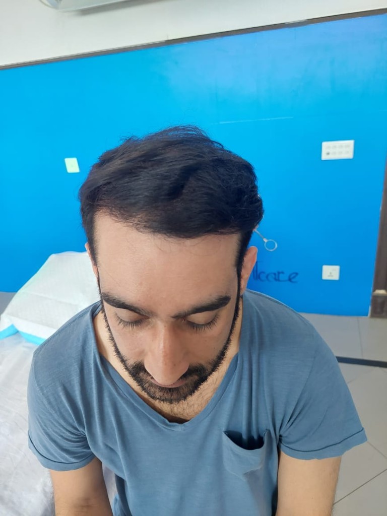 Hair-transplant-islamabad-01