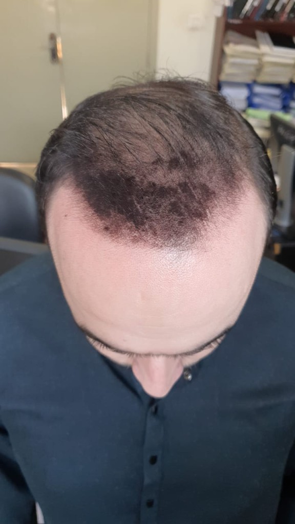 Hair-transplant-result-islamabad 