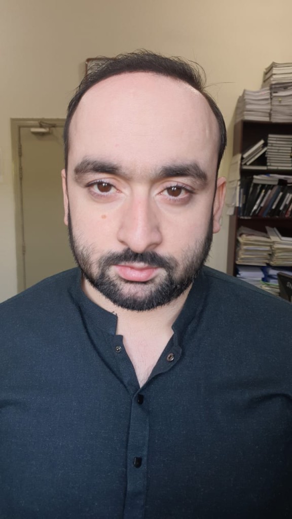 Hair-transplant-result-islamabad 