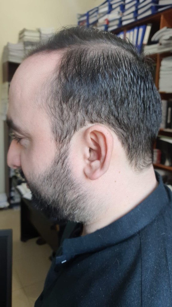 Hair-transplant-result-islamabad 