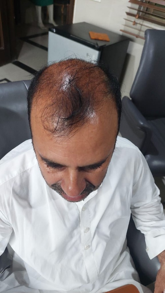 FUE Hair Transplant Result Islamabad