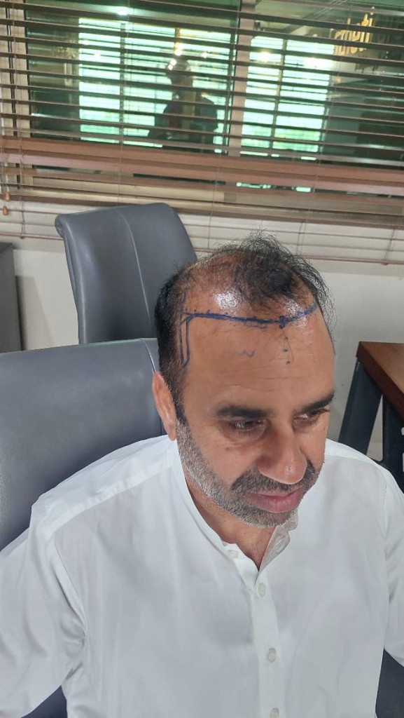 FUE Hair Transplant Result Islamabad