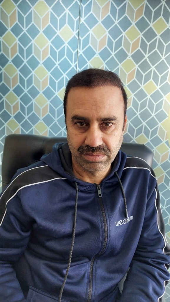 FUE Hair Transplant Result Islamabad