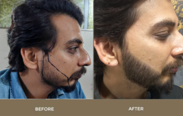 Beard Hair Transplant