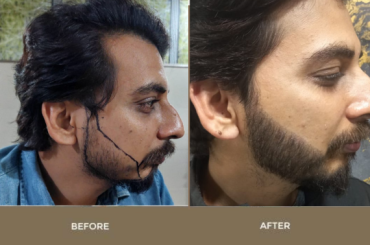 Beard Hair Transplant