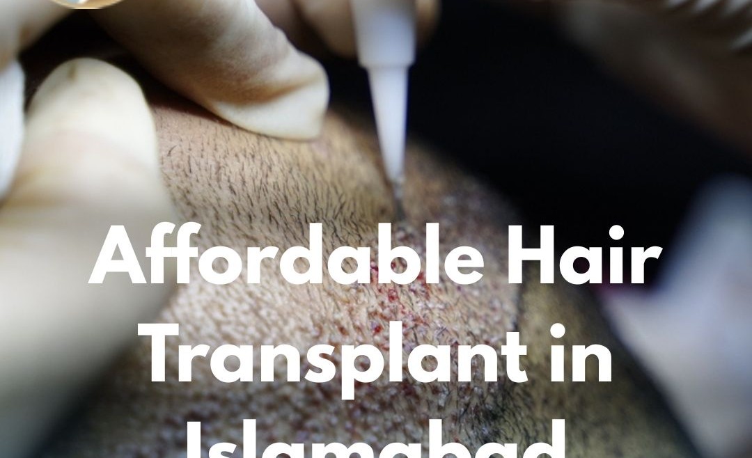 Affordable Hair Transplant in Islamabad – Your Complete Guide