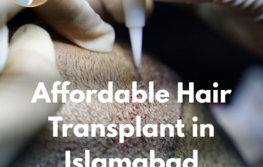 Affordable Hair Transplant in Islamabad – Your Complete Guide