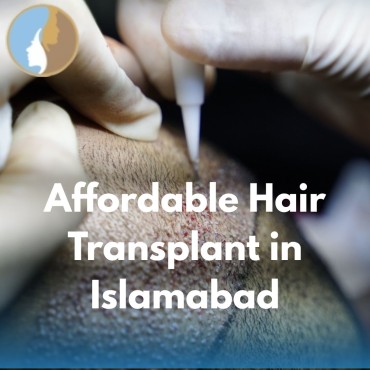 Affordable Hair Transplant in Islamabad – Your Complete Guide