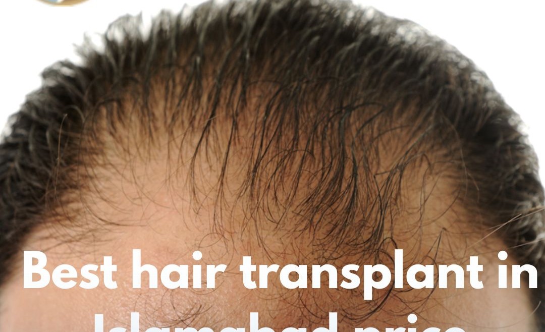 Best Hair Transplant in Islamabad Price – Your Complete Guide