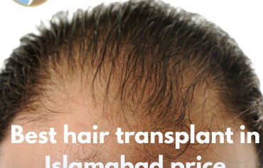 Best Hair Transplant in Islamabad Price – Your Complete Guide