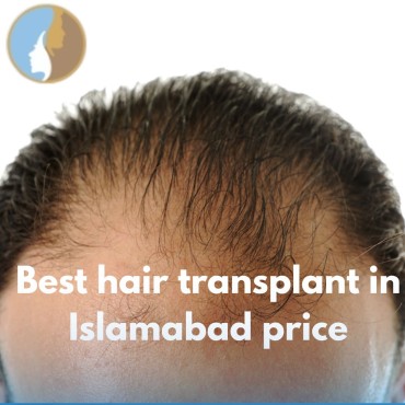 Best Hair Transplant in Islamabad Price – Your Complete Guide