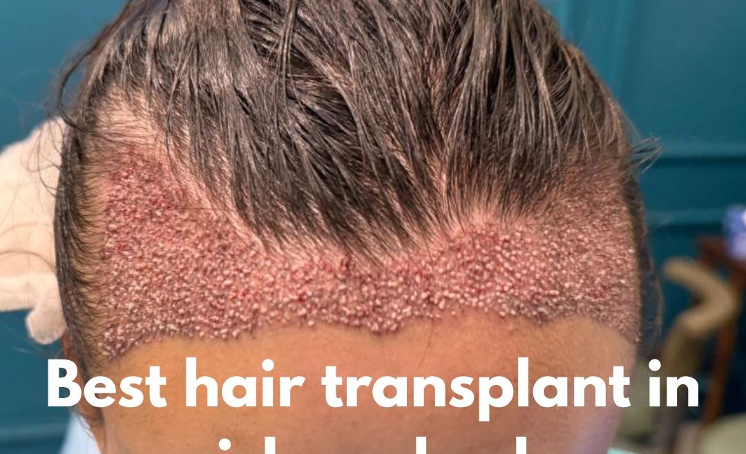Best Hair Transplant in Islamabad – Your Complete Guide