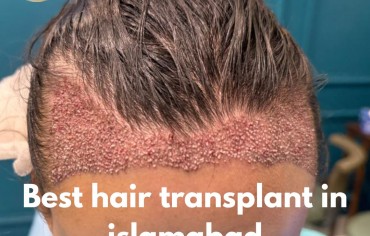Best Hair Transplant in Islamabad – Your Complete Guide