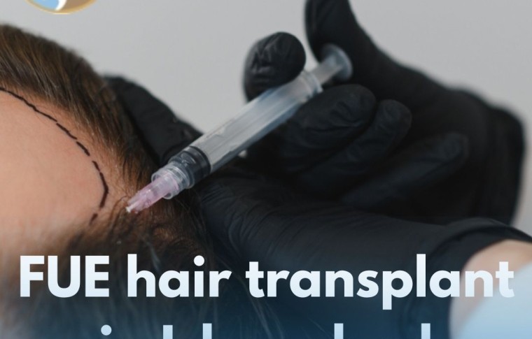 FUE Hair Transplant in Islamabad – Your Complete Guide