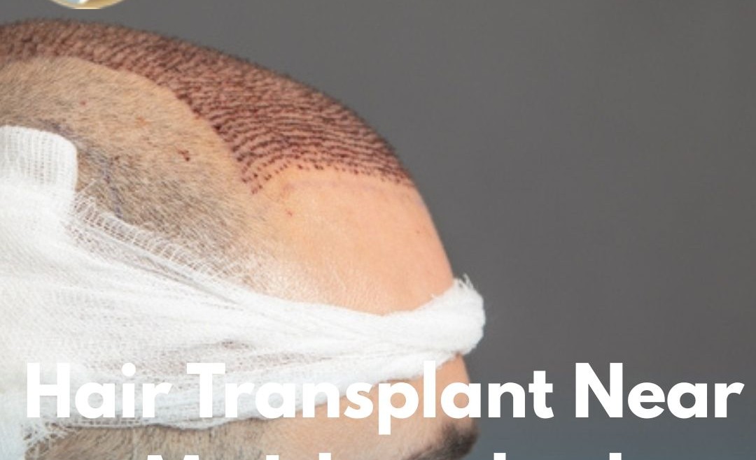 Hair Transplant Near Me Islamabad