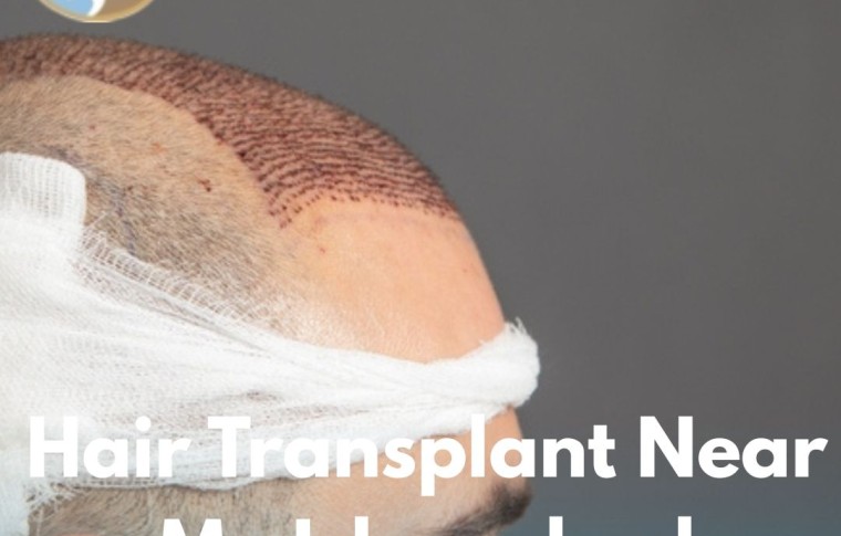Hair Transplant Near Me Islamabad