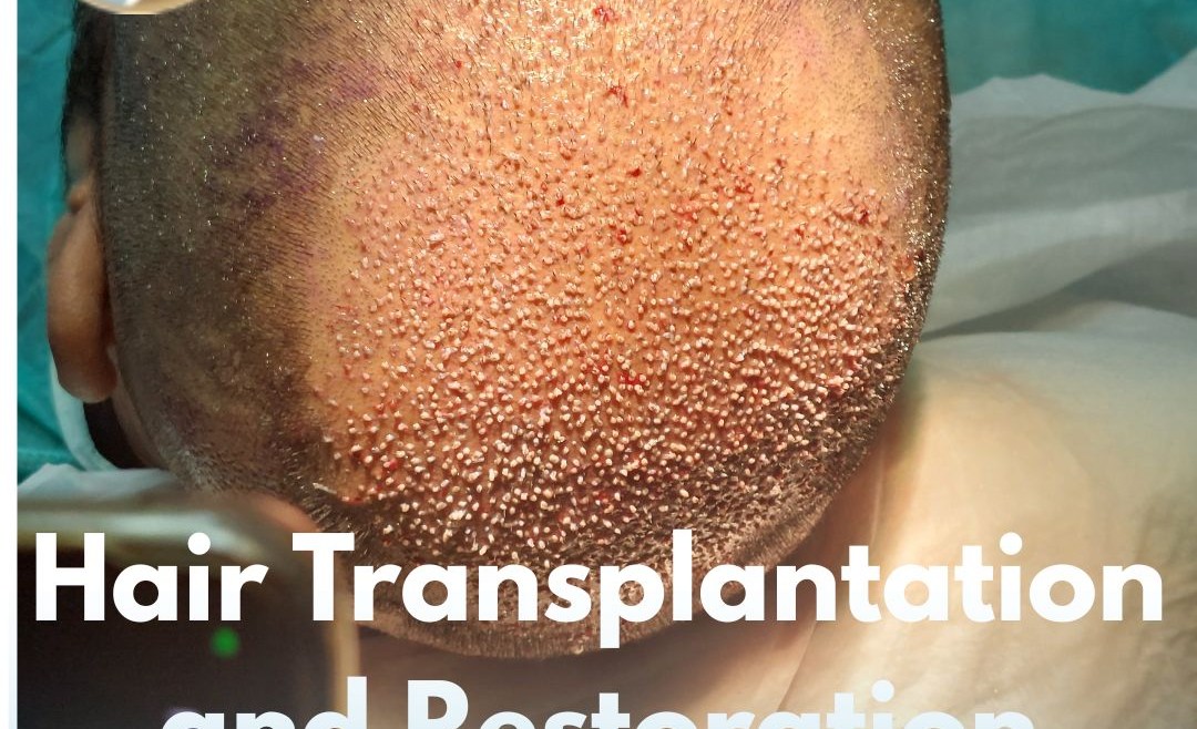 Hair Transplantation and Restoration