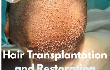 Hair Transplantation and Restoration