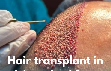 Hair Transplant in Islamabad Fees – A Complete Guide for You