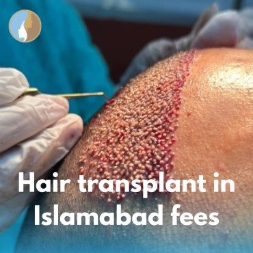 Hair Transplant in Islamabad Fees – A Complete Guide for You