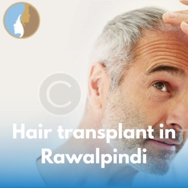Hair Transplant in Rawalpindi – Your Complete Guide to Natural Hair Restoration