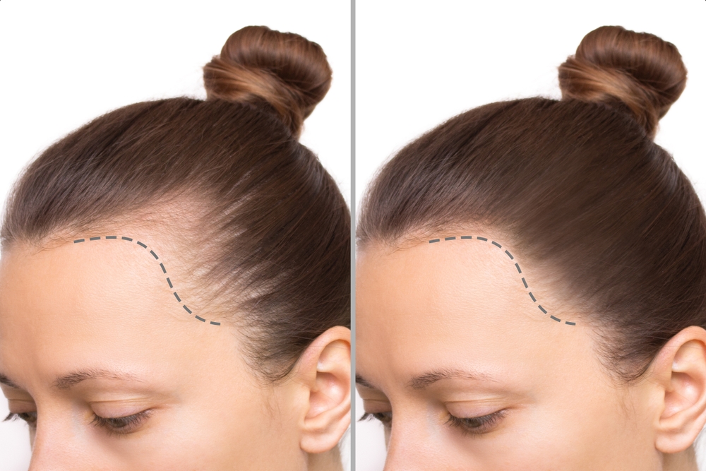 Hair transplant in islamabad fees