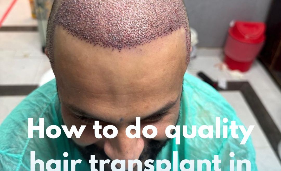 How to do quality hair transplant in Islamabad