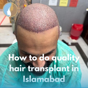 How to do quality hair transplant in Islamabad