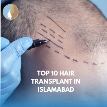 Top 10 Hair Transplant in Islamabad – Find the Best Clinics for You