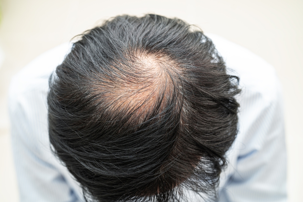 hair transplant clinic in Islamabad
