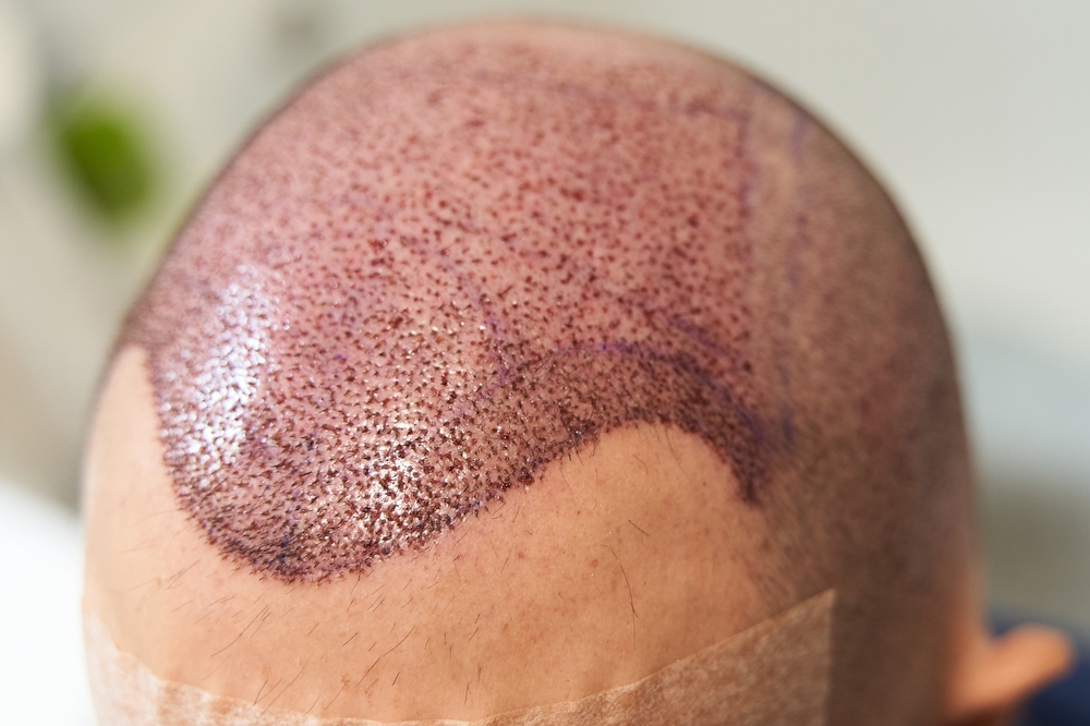 hair transplant clinic in Islamabad