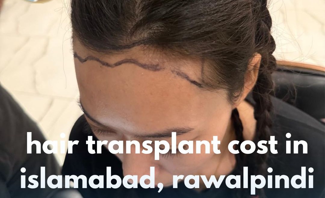 Hair Transplant Cost in Islamabad, Rawalpindi – Complete Guide for You