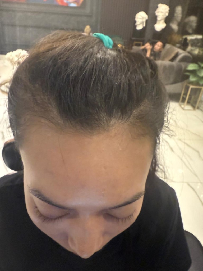 hair transplant cost in islamabad, rawalpindi