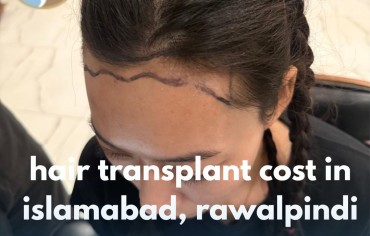 Hair Transplant Cost in Islamabad, Rawalpindi – Complete Guide for You
