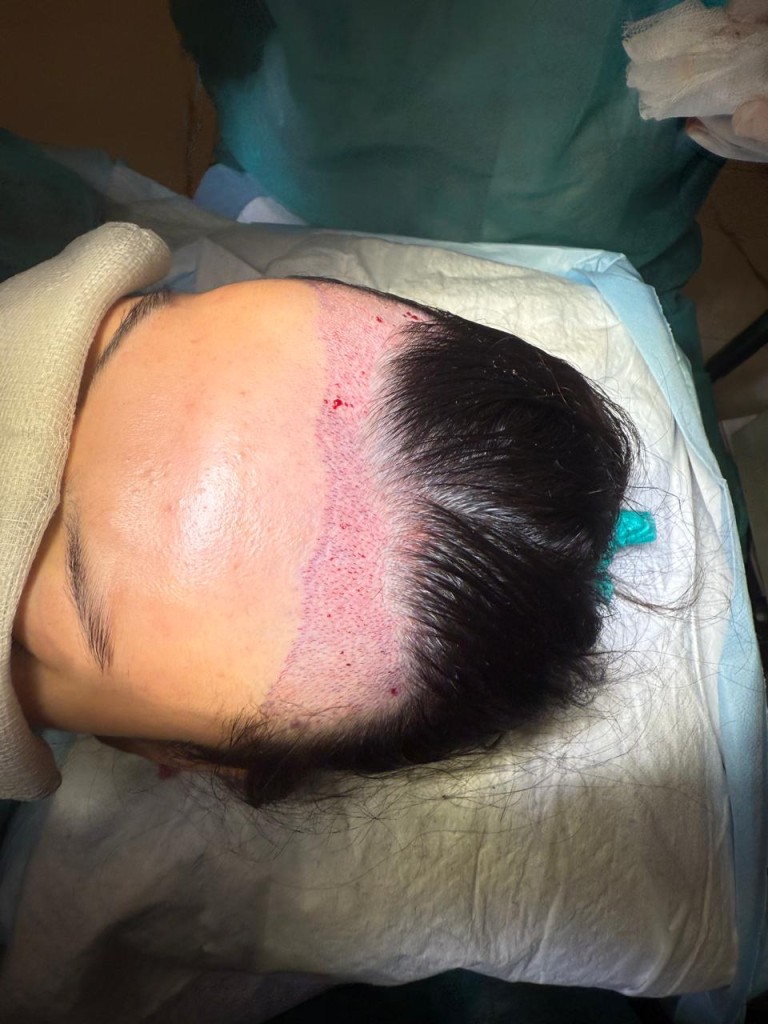 hair transplant cost in islamabad, rawalpindi