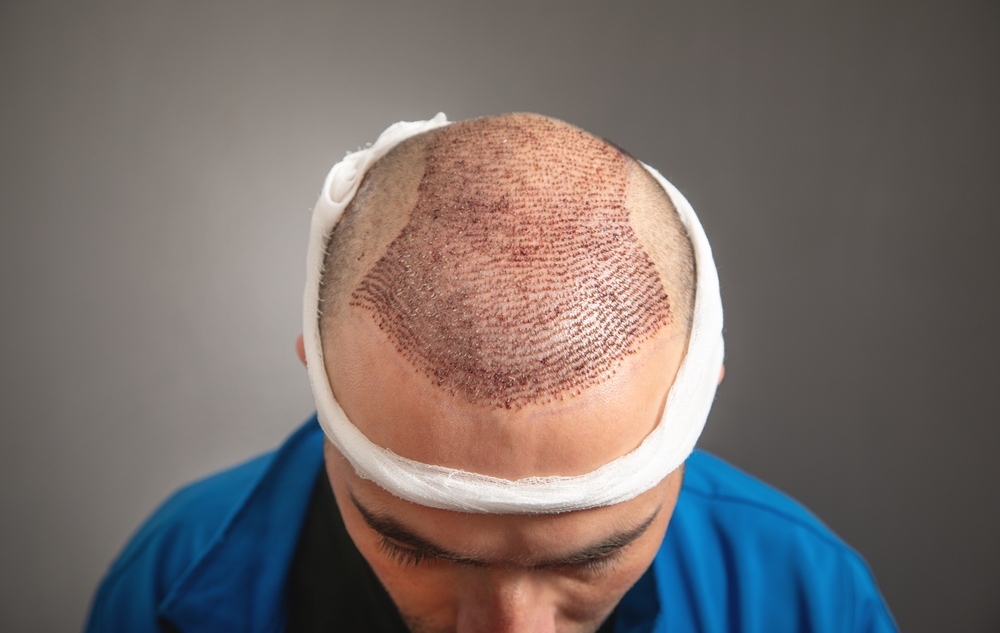 Best hair transplant in Islamabad price
