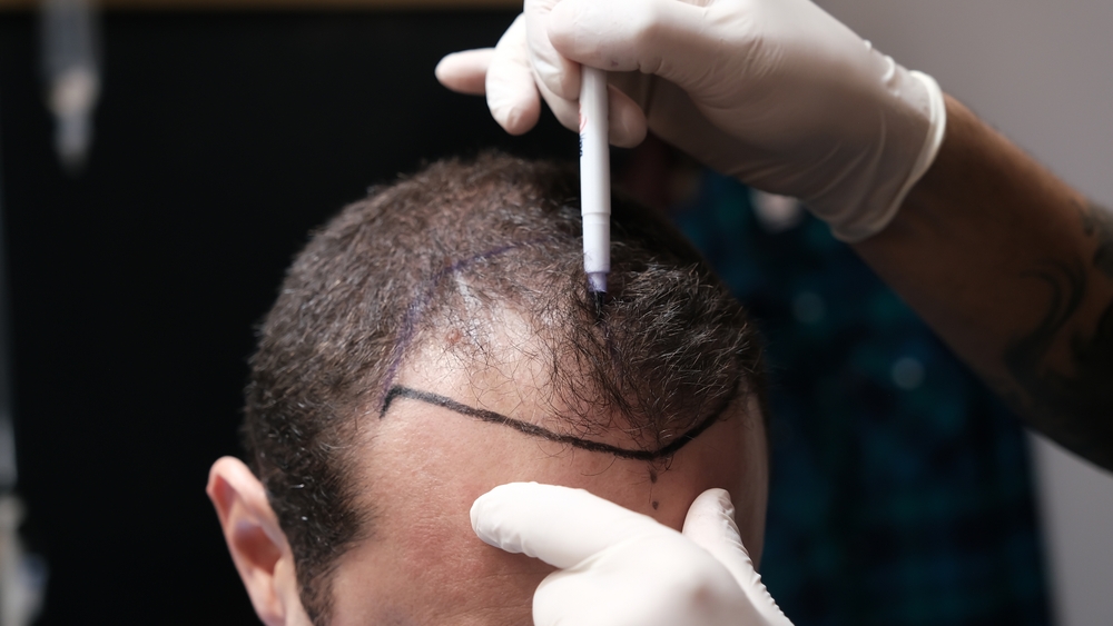 Top 10 hair transplant in islamabad