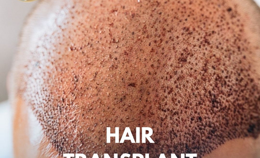 Hair Transplant in Islamabad – A Complete Guide for You