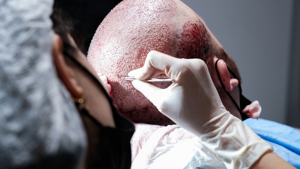 Top 10 hair transplant in islamabad