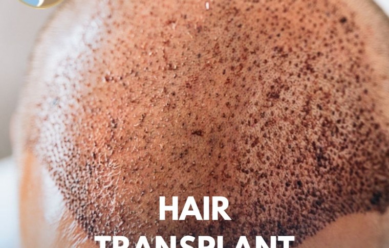 Hair Transplant in Islamabad – A Complete Guide for You