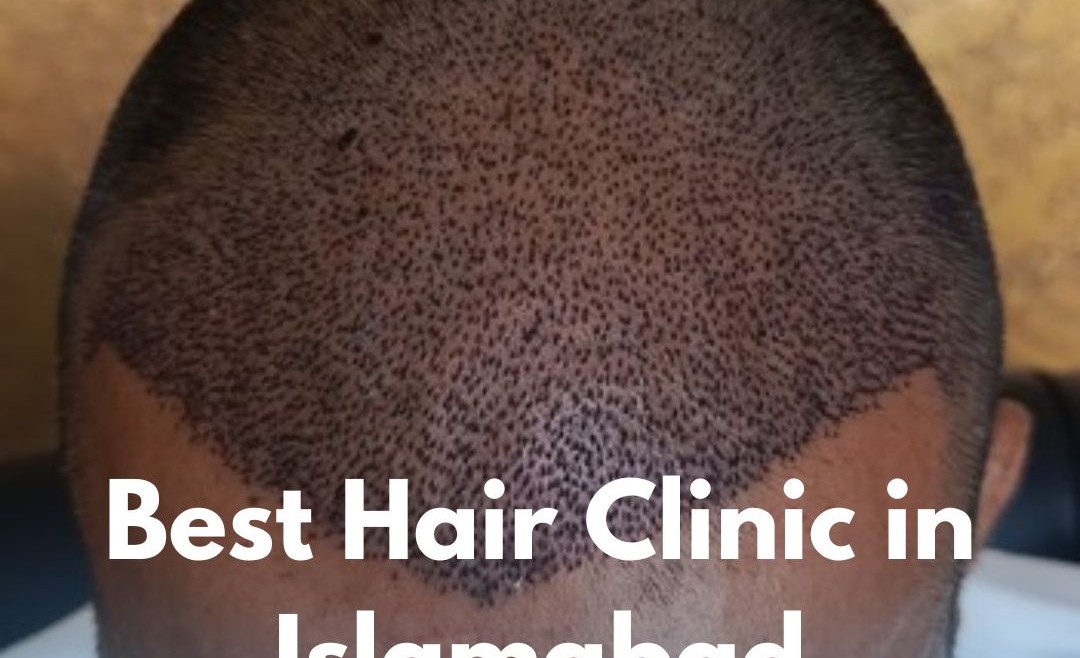 Best Hair Clinic in Islamabad