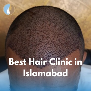 Best Hair Clinic in Islamabad